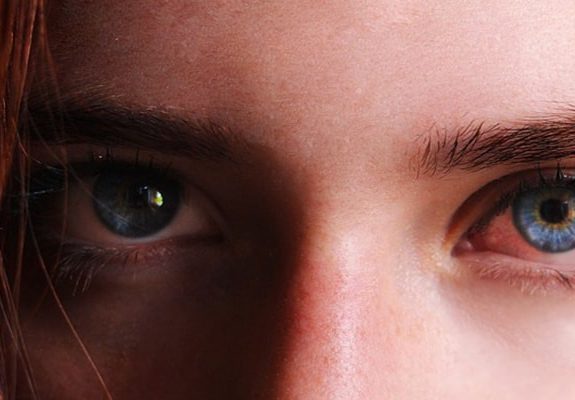 marijuana-addiction-bloodshot-eyes